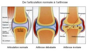 arthrite et arthrose